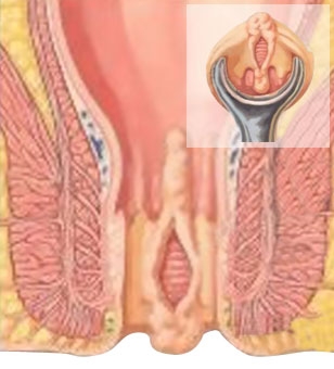 imagini fisura anala